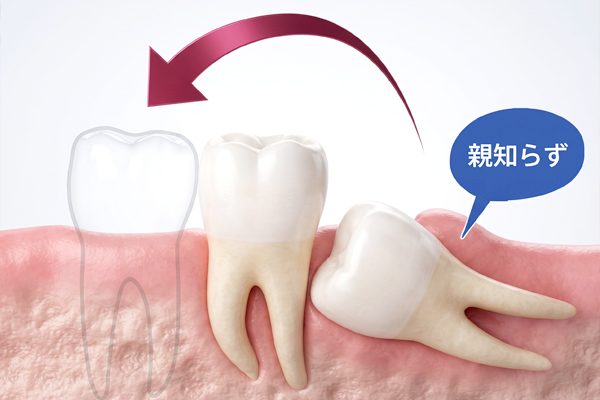 歯の移植(自家歯牙移植)の症例