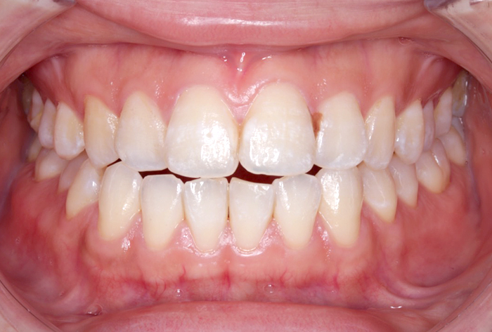 赤坂デンタルオフィスのインプラント