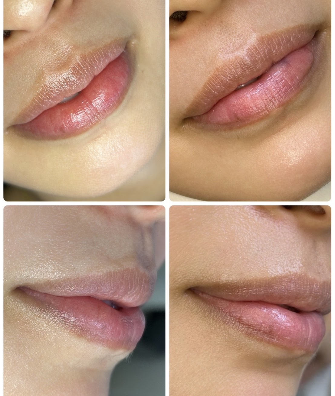 唇へのヒアルロン酸注入の症例.1