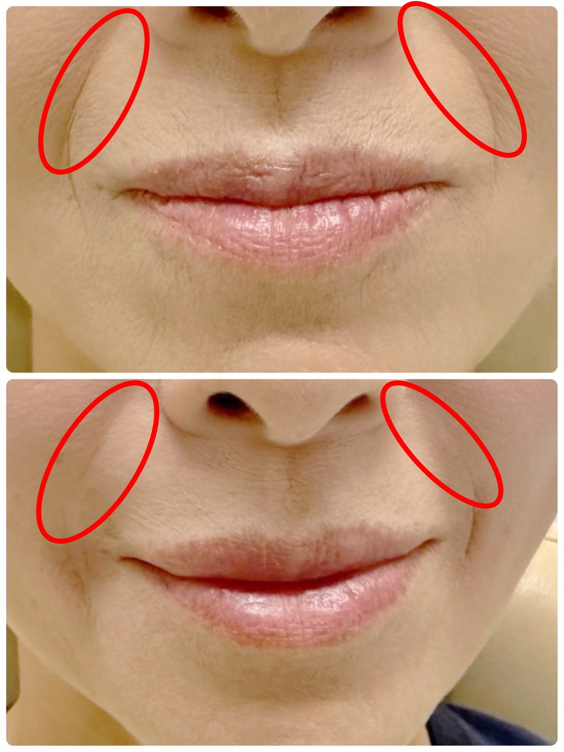 ヒアルロン酸注入によるほうれい線治療の症例.2