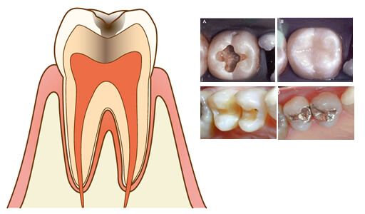 神谷町デンタルオフィスの虫歯治療