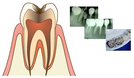 神谷町デンタルオフィスの虫歯治療