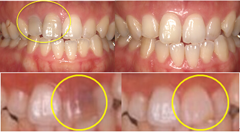 神谷町デンタルオフィスのホワイトニング